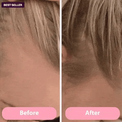 SHFTD™ Scalp Treatment System